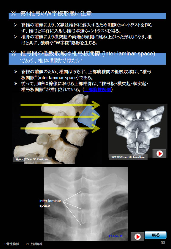 胸部Ｘ線写真、第1椎弓のW字様形態に注意