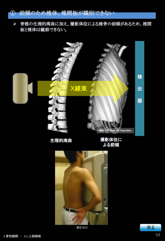 胸部Ｘ線写真、前傾のため椎体、椎間板識別できない。