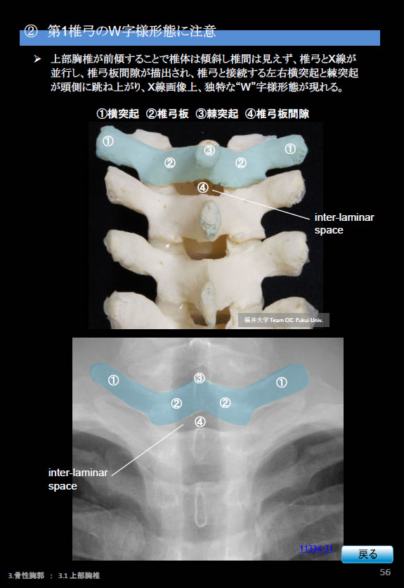 胸部Ｘ線写真、第1椎弓のW字様形態に注意
