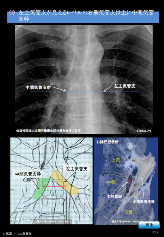 胸部Ｘ線写真、左主気管支が見えるレベルの右側気管支は主に中間気管支幹。